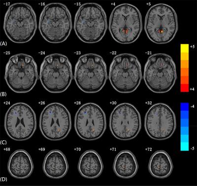 Altered Effective Connectivity of Children and Young Adults With Unilateral Amblyopia: A Resting-State Functional Magnetic Resonance Imaging Study